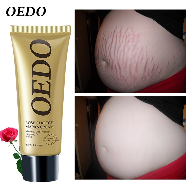 Rose Stretch Mark Removal Cream